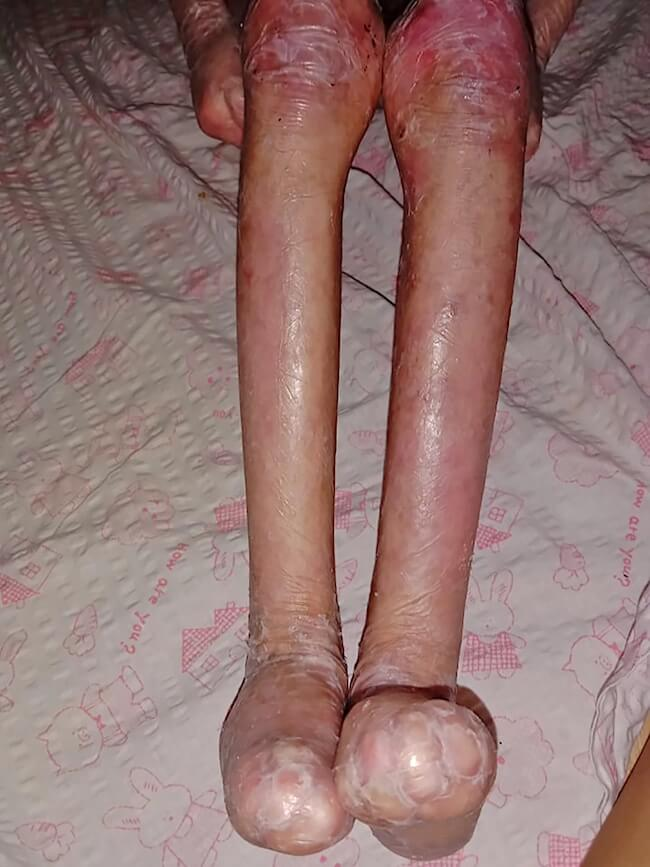 Shamila's legs and feet wrapped in damaged skin
