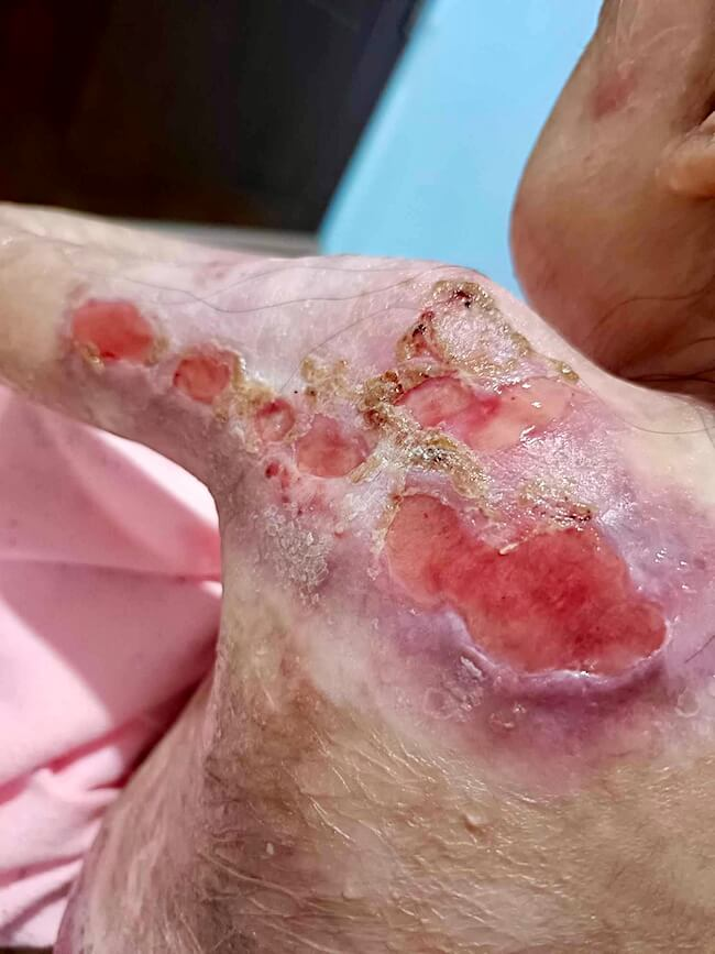 Close-up of Shamila's painful wounds
