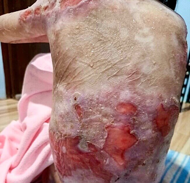 Open wounds on Shamila's back