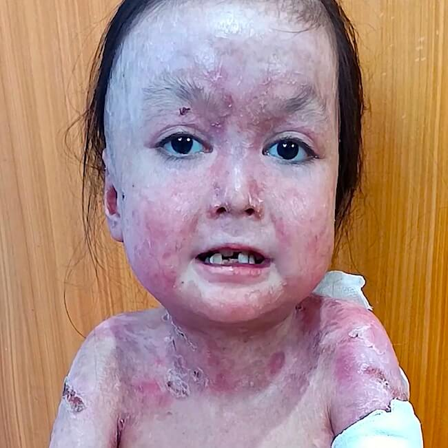 Shamila's face affected by severe blistering skin loss