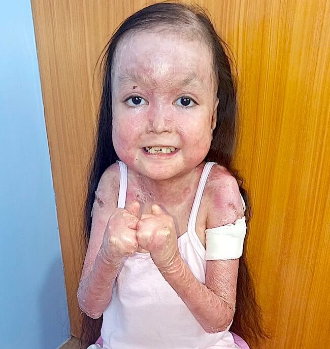 Shamila standing with bandaged arm